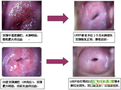 宫颈糜烂