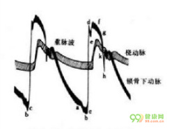 室性早搏