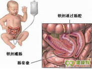 肠套叠