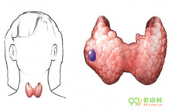 甲状腺结节